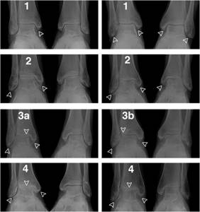 Stages of osteoarthritis of the ankle joint