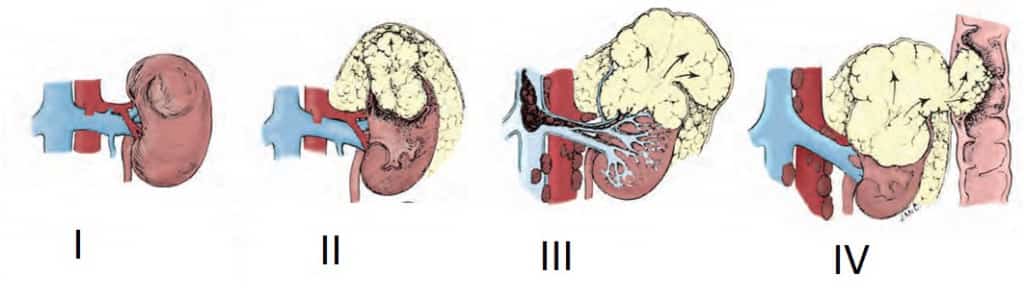 Stages of kidney cancer.jpg