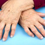 Stages of rheumatoid arthritis