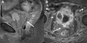 T2-weighted (A) sagittal and T1-post-contrast (B) axial images