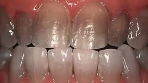 Tetracycline teeth treatment, whitening, veneers