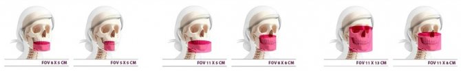 Types of modern CBCT machines - Field of view (FOV)