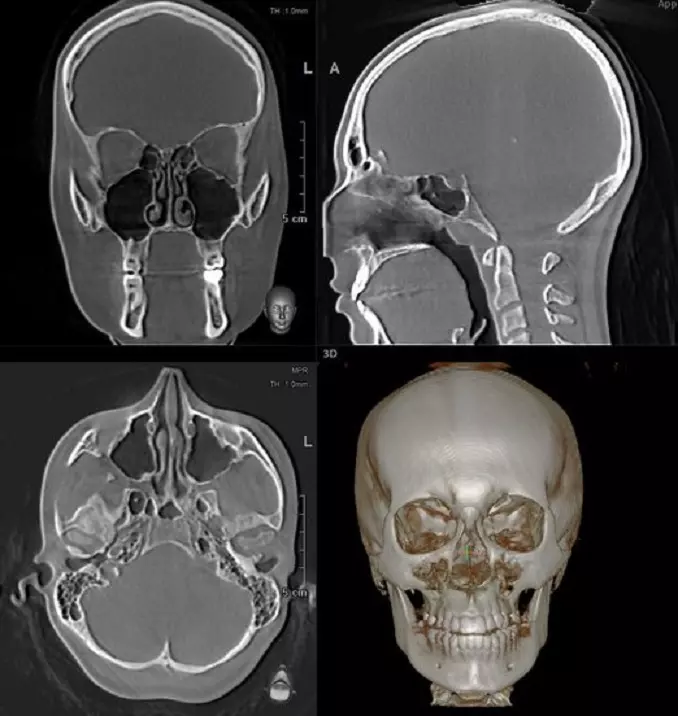 томография черепа