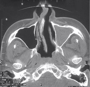 Total filling of the left maxillary sinus with fluid (blood?), damage to the nasal septum on a computed tomogram