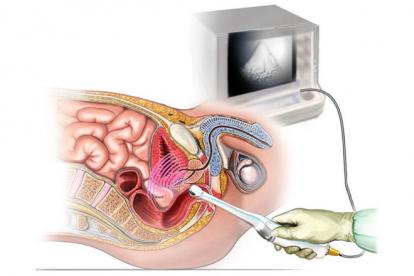 Transrectal ultrasound examination