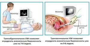 transvaginal ultrasound during pregnancy