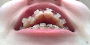 TRG of teeth