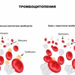 Thrombocytopenia.jpg