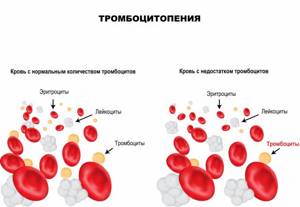 Thrombocytopenia.jpg