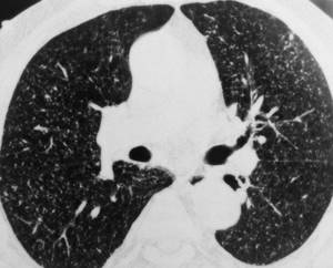 Pulmonary tuberculosis on CT (multiple foci)