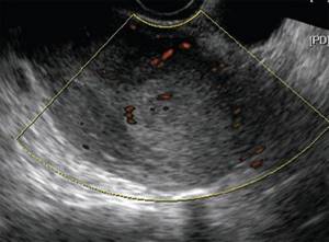 TVUS, Color Doppler, longitudinal scanning, stage Ia endometrial cancer, infiltrative formation of a hyperechoic structure in the area of ​​the fundus of the uterus with reduced vascularization