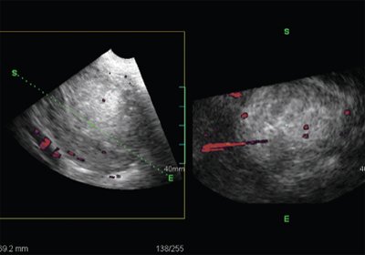 TVUS, energy mapping mode, ultrasound performed using Oblique view technology, 3D volumetric data make it possible to clarify the state of the endometrium and the nature of endometrial and subendometrial vascularization
