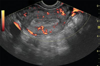 TVUS, energy mapping mode, glandular cystic endometrial hyperplasia