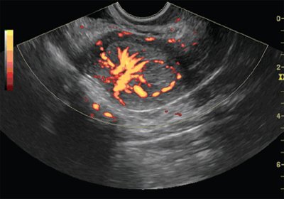 TVUS, combination of B-mode and energy mapping mode, stage IV endometrial cancer, focus of hypervascularization along the posterior wall of the uterus with hypervascular endometrial blood flow
