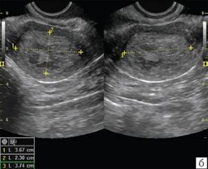 TVUS, B-mode, transverse scanning, stage Ib endometrial cancer, determination of the endometrial invasion index