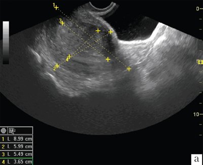 TVUS, B-mode, longitudinal scanning, stage Ib endometrial cancer, determination of the endometrial invasion index