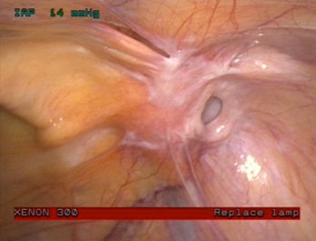 removal of inguinal hernia photo