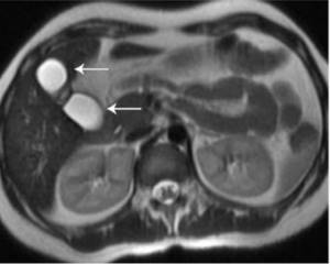 doubling on MRI of the gallbladder