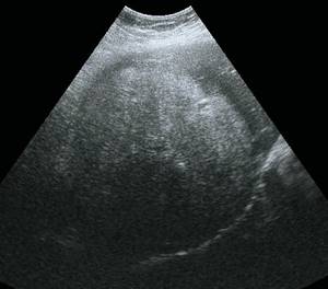 Ultrasound picture of liver adenoma: B-mode, volumetric formation of the VI-VII segment of the right lobe of the liver, heterogeneous, predominantly of increased echogenicity, with small hypoechoic zones, with smooth clear contours, hypoechoic rim