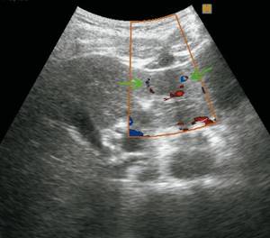 Ultrasound picture of FNH of the liver in patient G: color flow mode, the feeding artery is determined
