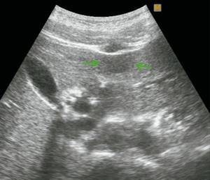 Ultrasound picture of FNH of the liver in patient G: B-mode, in the left lobe of the liver, in segment III, a hypoechoic formation measuring 28 x 16 mm is visualized subcapsularly, with clear, even contours