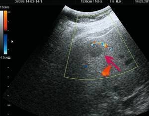 Ultrasound picture of FNH of the liver in patient R: color flow mode, the feeding artery is determined