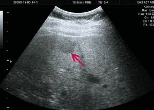 Ultrasound picture of FNH of the liver in patient R: B-mode, in the right lobe of the liver a hypoechoic formation up to 20 mm is visualized, with clear, even contours