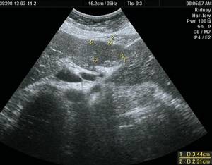 Ultrasound picture of FNH of the liver: B-mode, in the IV segment of the liver, reaching the contour of the liver, deforming it, a hypoechoic tissue density formation, somewhat heterogeneous in echostructure, measuring 50 x 40 mm, irregular in shape, with clear even contours is visualized