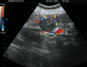 Ultrasound picture of FNH of the liver: in the Color Doppler mode, pronounced blood flow in the form of a basketball basket, the feeding artery is determined