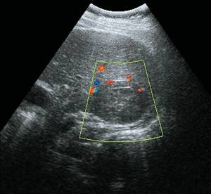 Ultrasound picture of liver metastasis: CD mode, avascular formation