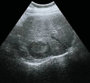 Ultrasound picture of liver metastasis: B-mode, in the posterior diaphragmatic parts of the liver a volumetric formation measuring 50 x 37 mm is visualized, tissue density, isoechoic, heterogeneous in echo structure, with a pronounced hypoechoic rim