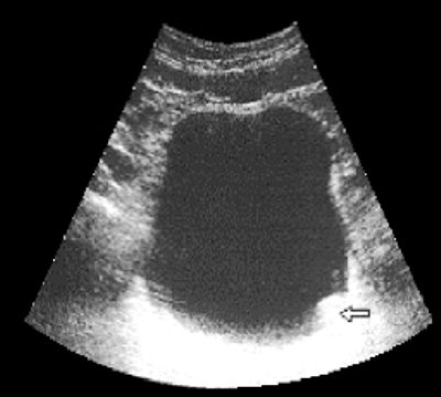 Ultrasound polycystogram for a bladder tumor (arrow) stage T1 (b)
