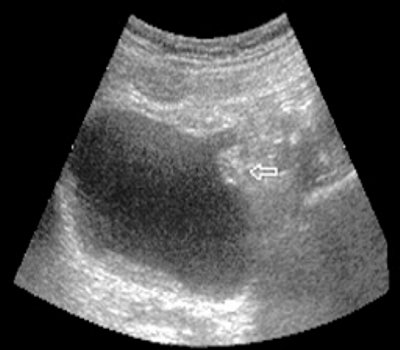 Ultrasound polycystogram for a bladder tumor (arrow) stage T3 (b)