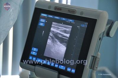 Ultrasound scanner for studying the venous system of the lower extremities