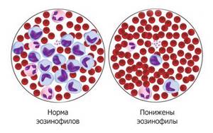 Level of eosinophils in the blood
