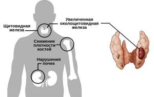 Увеличение околощитовидной железы при гиперпаратиреозе