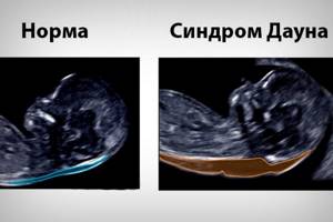 Ultrasound of Down&#39;s disease