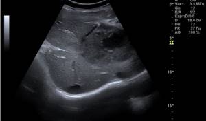 Ultrasound of the child&#39;s abdomen
