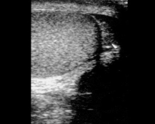 Ultrasound: Head of the epididymis