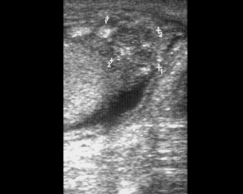 Ultrasound: Chronic epididymitis
