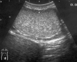 Ultrasound: Chronic orchitis