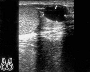 Ultrasound: Epididymal head cyst