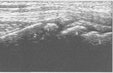 УЗИ лучезапястного сустава (12 лет). Продольное сканирование по тыльной поверхности вдоль оси I пальца.