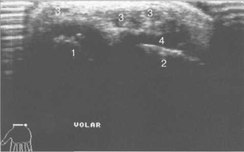УЗИ лучезапястного сустава (6—7 лет). Поперечное сканирование по ладонной поверхности.