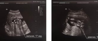 UZI mi zh 1024x367 - Determining the sex of the unborn child