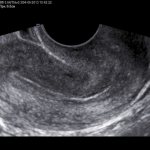 ultrasound of the uterus