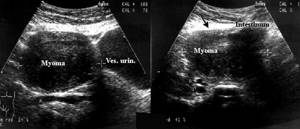 Ultrasound of uterine fibroids
