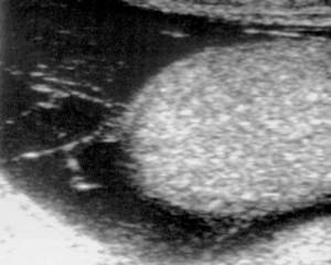 Ultrasound: Multilocular hydrops