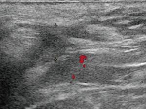Ultrasound of the soft tissues of the perineum (CDC mode) - 14 days after surgery, the vascular reaction in the subcutaneous fat is not determined