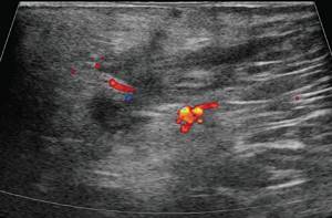 Ultrasound of the soft tissues of the perineum (CDC mode) - 3 days after surgery, a decrease in the severity of the vascular reaction is noted in the subcutaneous fat along the periphery of the hypoechoic formation